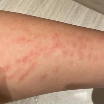 Philips Kullanım Sonrası Cilt Tahrişi Ve Yetersiz Destek