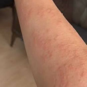 Philips Kullanım Sonrası Cilt Tahrişi Ve Yetersiz Destek