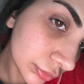 Aldığım Kaş Ve Kirpik Serumu Cildimde Olumsuz Sonuçlara Yol Açtı