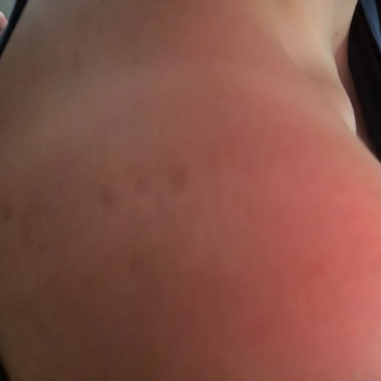 Nivea 50 Faktör Sprey Bu Yıl Koruma Sağlamadı Eşimin Sırtı Yandı