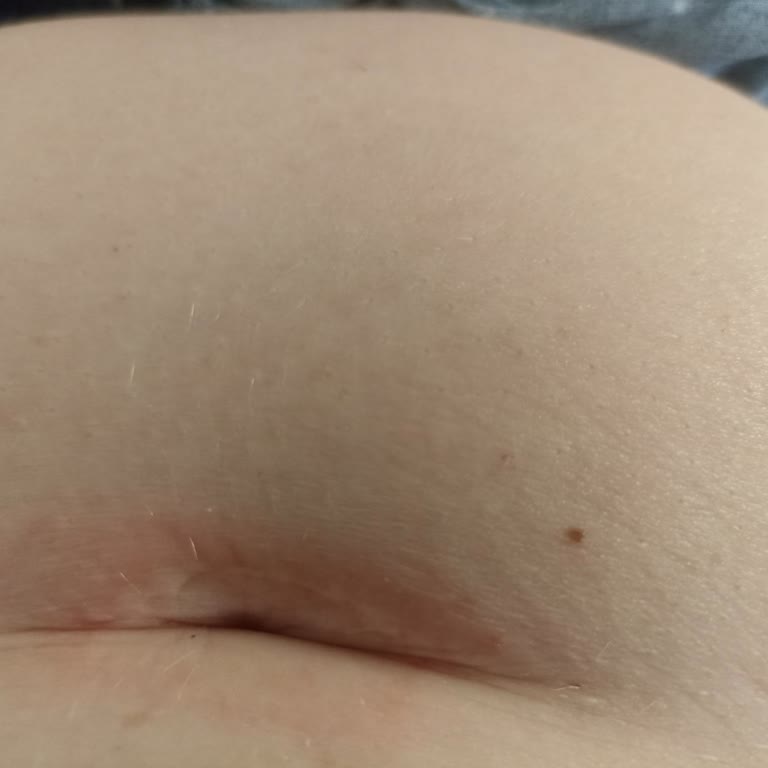 Yan Etkisiz Denilen Bant Alerji Yaptı Ve Beklentimi Karşılamadı