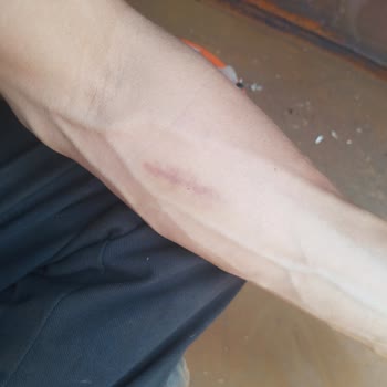 Özel Mercan Hastanesi Kolumu Mahvetti