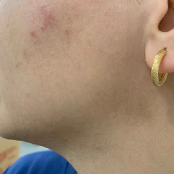 İğneli Epilasyon Sonrası Yüzümde Yanıklar Oluştu, Ücret İadesi Yapılmadı