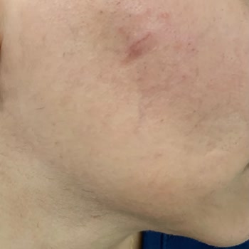 İğneli Epilasyon Sonrası Yüzümde Yanıklar Oluştu, Ücret İadesi Yapılmadı