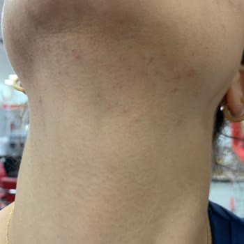 İğneli Epilasyon Sonrası Yüzümde Yanıklar Oluştu, Ücret İadesi Yapılmadı