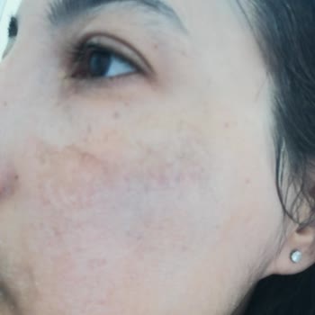 Bioderma Güneş Kremi Ve Diğer Ürünlerde Ciltte Olumsuz Etkiler Ve Zarar