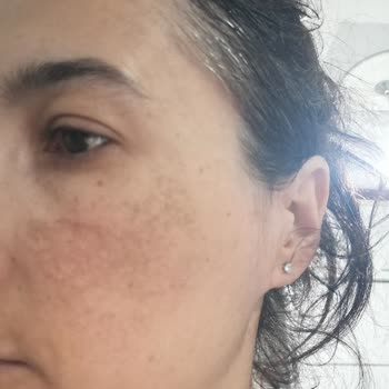 Bioderma Güneş Kremi Ve Diğer Ürünlerde Ciltte Olumsuz Etkiler Ve Zarar