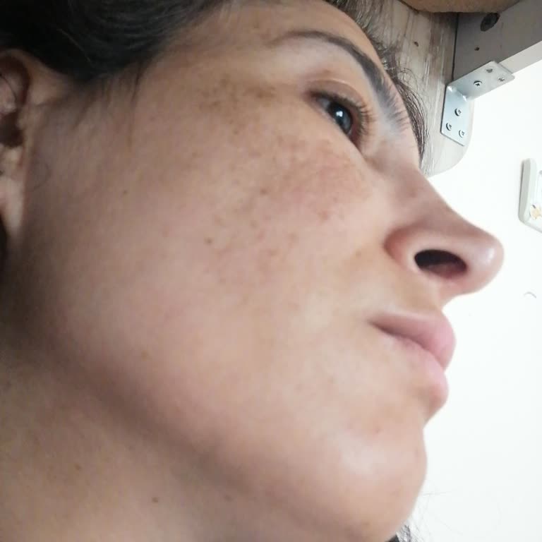 Bioderma Güneş Kremi Ve Diğer Ürünlerde Ciltte Olumsuz Etkiler Ve Zarar