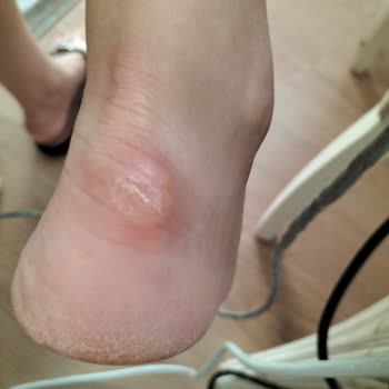 Skechers Ayakkabıda Arka Astar Sorunu Ve İade Reddi