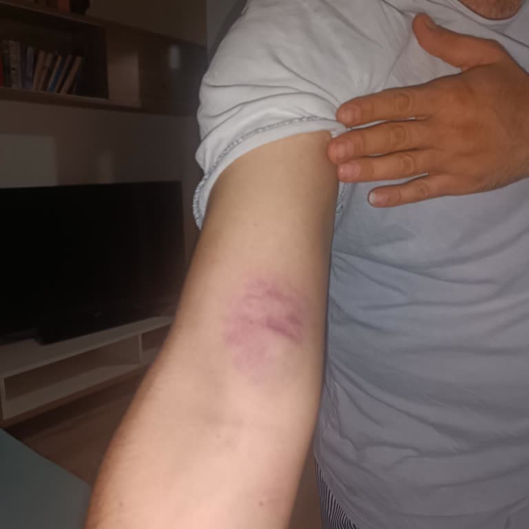 Türk Kızılay Kan Bağışı Sonrası Yaşanan Sağlık Sorunu Ve Hayal Kırıklığı