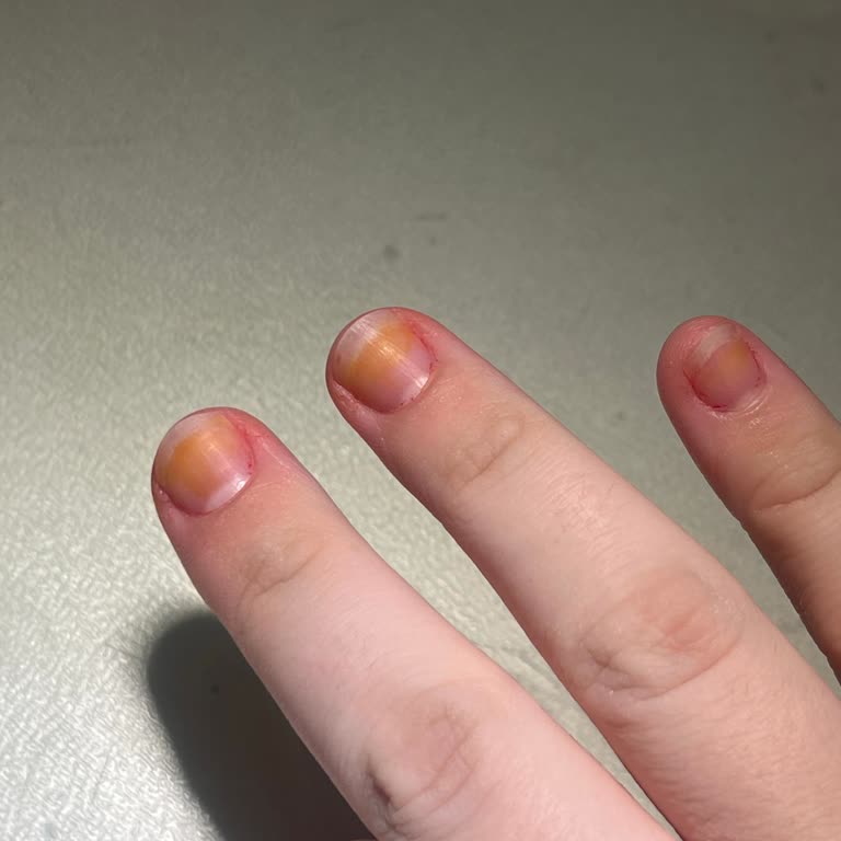 Flormar Oje Sonrası Tırnakta Sararma Ve Sağlık Endişesi