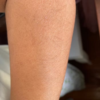 Lazer Epilasyon Sonrası Artan Tüyler Ve Randevu Karmaşası Yaşadık