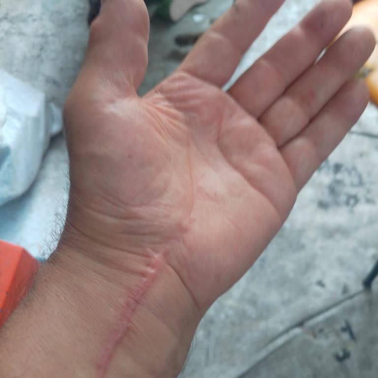 Düştükten Sonra Elimi Kaybettim Röntgenim Silindi Kimse İlgilenmiyor