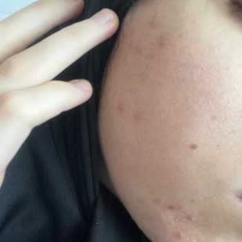 My La Roche-Posay Skincare Ruined My Skin