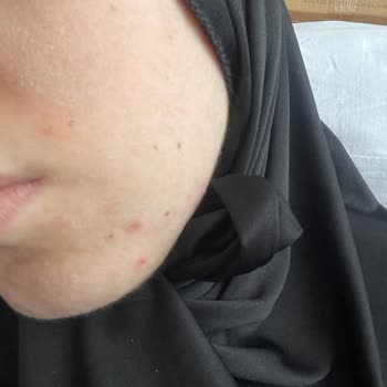 My La Roche-Posay Skincare Ruined My Skin