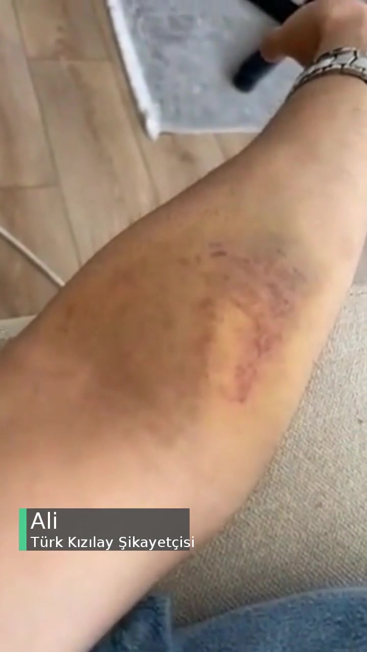 Türk Kızılay Kan Bağışı Yaptıktan Sonra Kolundaki Oluşan Morluk! videonun kapak resmi