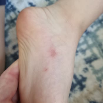 Aldığım Çocuk Sandaleti Oğlumun Ayağını Yaraladı Ve Kayganlığı Yüzünden Düştü