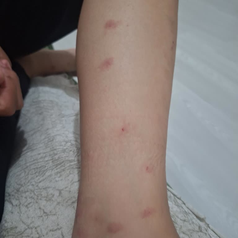 Bursa'da Yetersiz Sivrisinek İlaçlaması Nedeniyle Yaşanan Mağduriyet