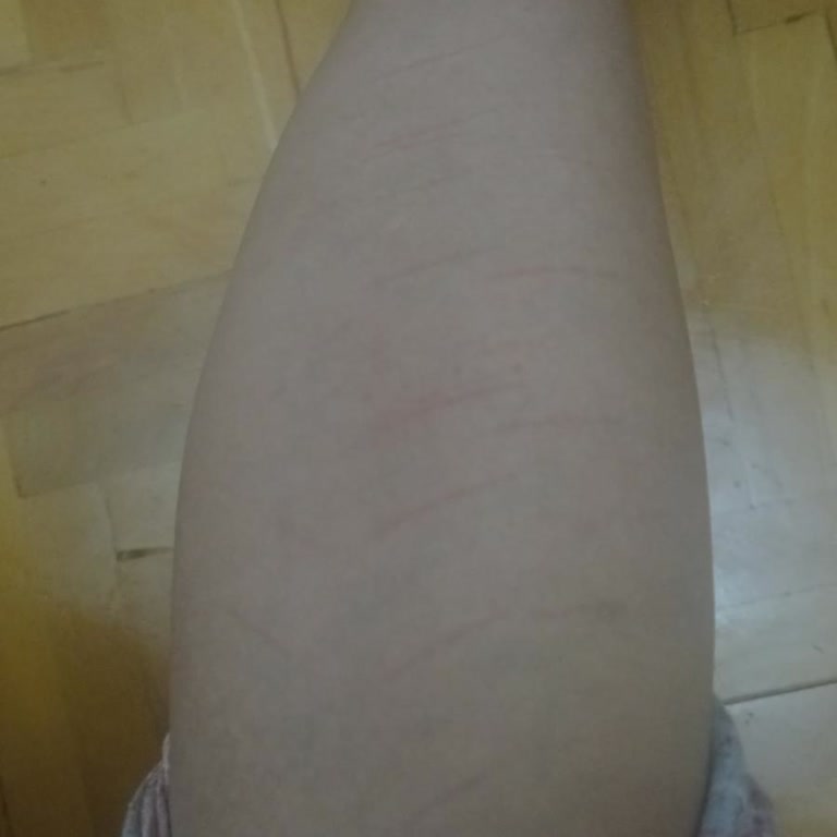 Epi Center Güzellik Yanlış Uygulama Sonucu Kalıcı Yanık İzleri Oluştu