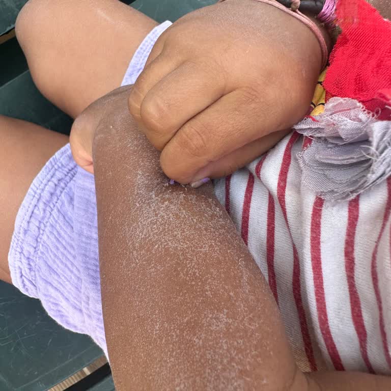 Bebek Güneş Kremi Ciltte Yanık Ve Kaşıntı Yaptı, Hayal Kırıklığı Yaşadık