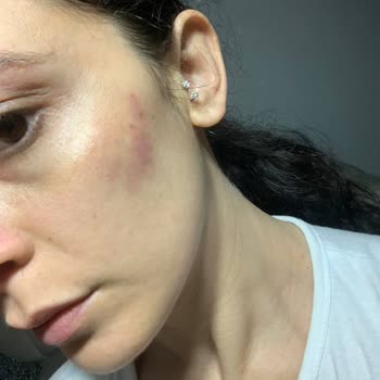 Cilt Bakımı Sonrası Yüzümde Korkunç İzler Oluştu