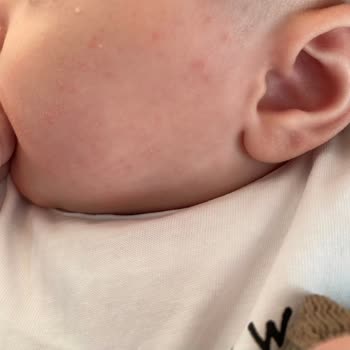 Hipp Bebek Sütü Alerji Yaptı, Acil Açıklama Bekliyorum