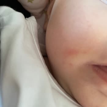 Hipp Bebek Sütü Alerji Yaptı, Acil Açıklama Bekliyorum