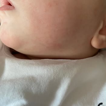 Hipp Bebek Sütü Alerji Yaptı, Acil Açıklama Bekliyorum