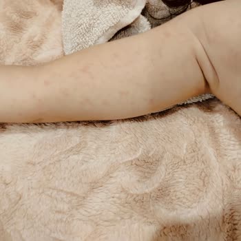 Bilim İlaç Yan Etki Gösteren İlaç Nedeniyle Yaşanan Mağduriyet Ve Sorumluluk Endişesi