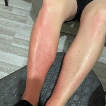 Isana Güneş Kremi Kullanımı Sonrası Ciltte Su Toplaması Ve Yanık