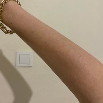 Isana Güneş Kremi Kullanımı Sonrası Ciltte Su Toplaması Ve Yanık