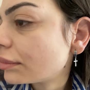 Kırmızı Peeling Serumu Sonrası Ciltte Ağrılı Sivilceler Ve Kalıcı Hasar