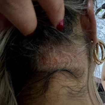 Kuaförde Saç Boyama Sonrası Ciddi Yanık Ve İlgisiz Yaklaşım