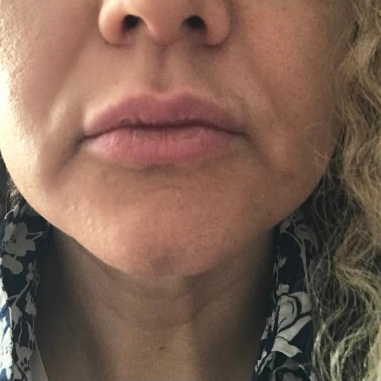 LeonArt Polikliniği Dudak Dolgusu Sonucu Çok Kötü!