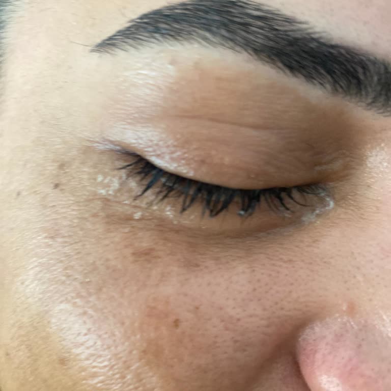 Ameliyat Sonrası İlgisizlik Ve Devam Eden Göz Sorunları