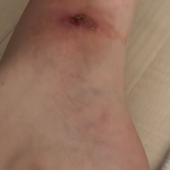 Bershka Aldığım Ürün Ayağımda Yara Oluşturdu