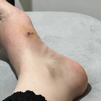 Bershka Aldığım Ürün Ayağımda Yara Oluşturdu