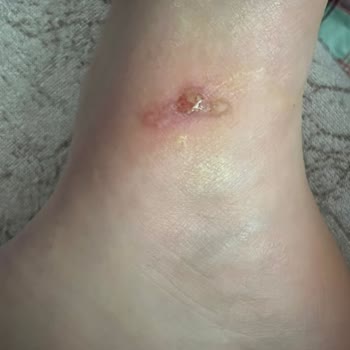 Bershka Aldığım Ürün Ayağımda Yara Oluşturdu