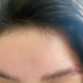 Kaş Silme İşlemi Sonrası Geçmeyen Kızarıklık Ve Hayal Kırıklığı