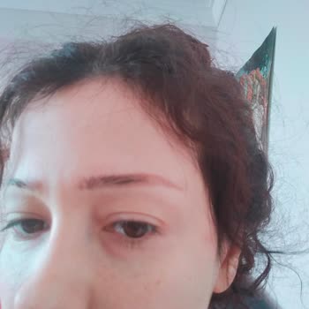 Kaş Silme İşlemi Sonrası Geçmeyen Kızarıklık Ve Hayal Kırıklığı