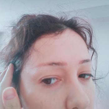 Kaş Silme İşlemi Sonrası Geçmeyen Kızarıklık Ve Hayal Kırıklığı