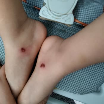 Ebebek'ten Alınan Terlikler Çocuğumun Ayağını Yaraladı