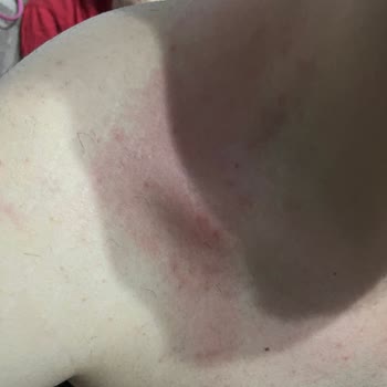 Sebamed Şampuan Alerjik Reaksiyona Yol Açtı