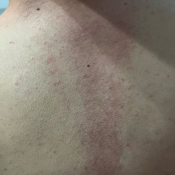 Sebamed Şampuan Alerjik Reaksiyona Yol Açtı