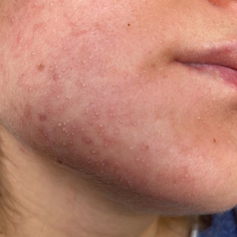 Neutrogena Yüz Yıkama Jeli Cildimde Şiddetli Reaksiyona Sebep Oldu