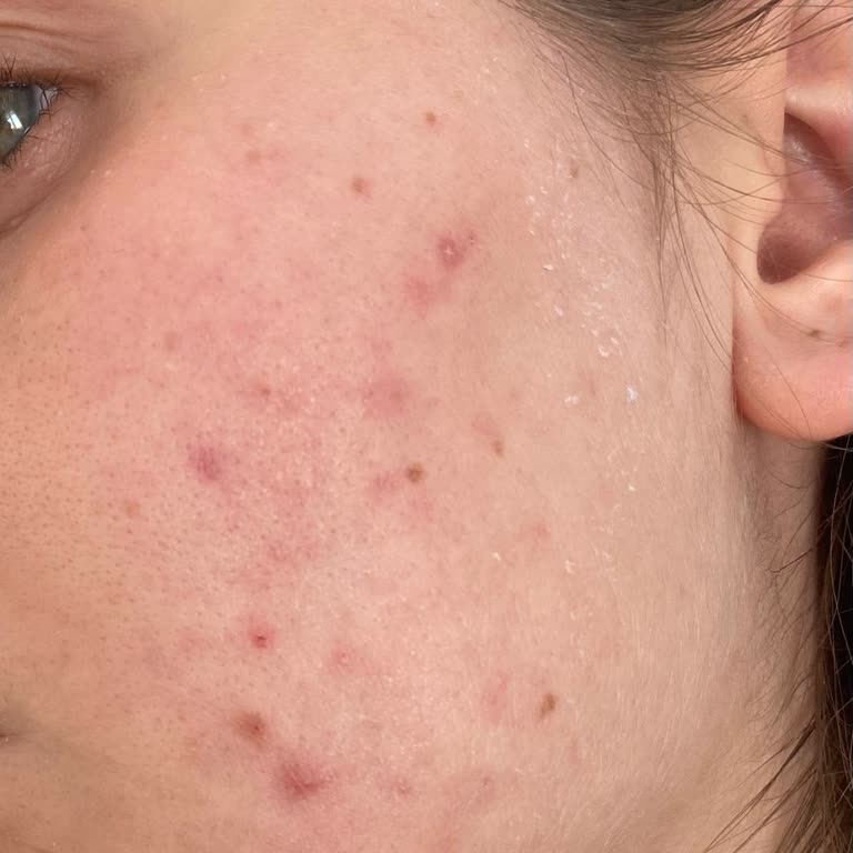 Neutrogena Yüz Yıkama Jeli Cildimde Şiddetli Reaksiyona Sebep Oldu