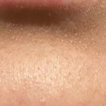 Neutrogena Yüz Yıkama Jeli Cildimde Şiddetli Reaksiyona Sebep Oldu