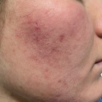 Neutrogena Yüz Yıkama Jeli Cildimde Şiddetli Reaksiyona Sebep Oldu