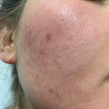 Neutrogena Yüz Yıkama Jeli Cildimde Şiddetli Reaksiyona Sebep Oldu