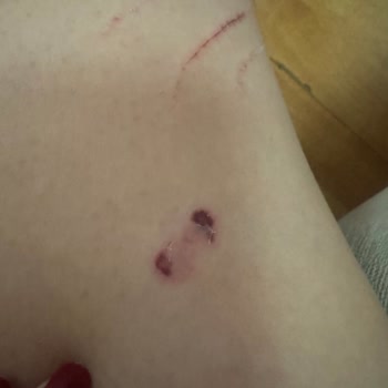 Acil Tedavi Sonrası 6 Ay Sonra Gelen Ücret Mesajı Şaşkınlığı